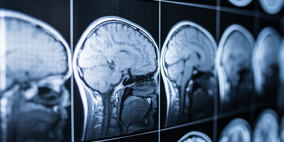 Hartford Traumatic Brain Injury Attorneys